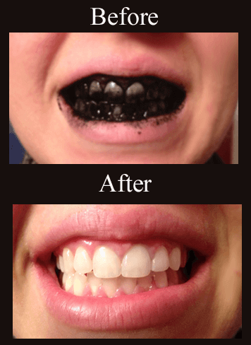 how to whiten teeth naturally with charcoal Best Way to Whiten Teeth Naturally 