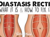 Diastasis Recti What it is and how to fix it 200x150