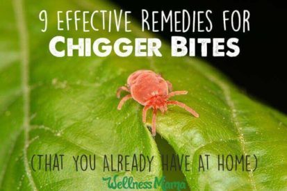 9 Effective Remedies for Chigger Bites