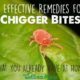 9 Effective Remedies for Chigger Bites