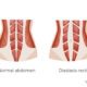Diastasis Recti - What it is and how to fix it