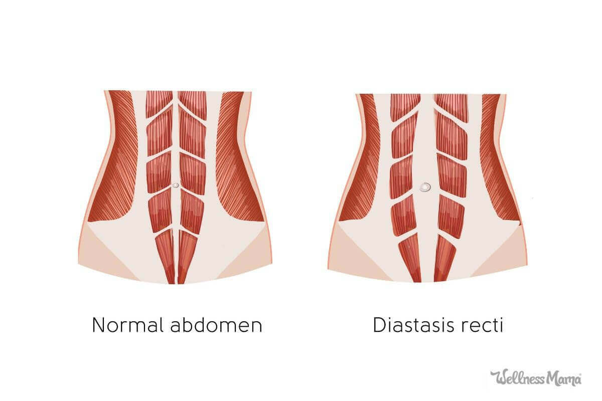 Diastasis Recti - What it is and how to fix it