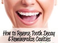 How to reverse tooth decay and cavities naturally
