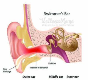Remedios para el oído de nadador