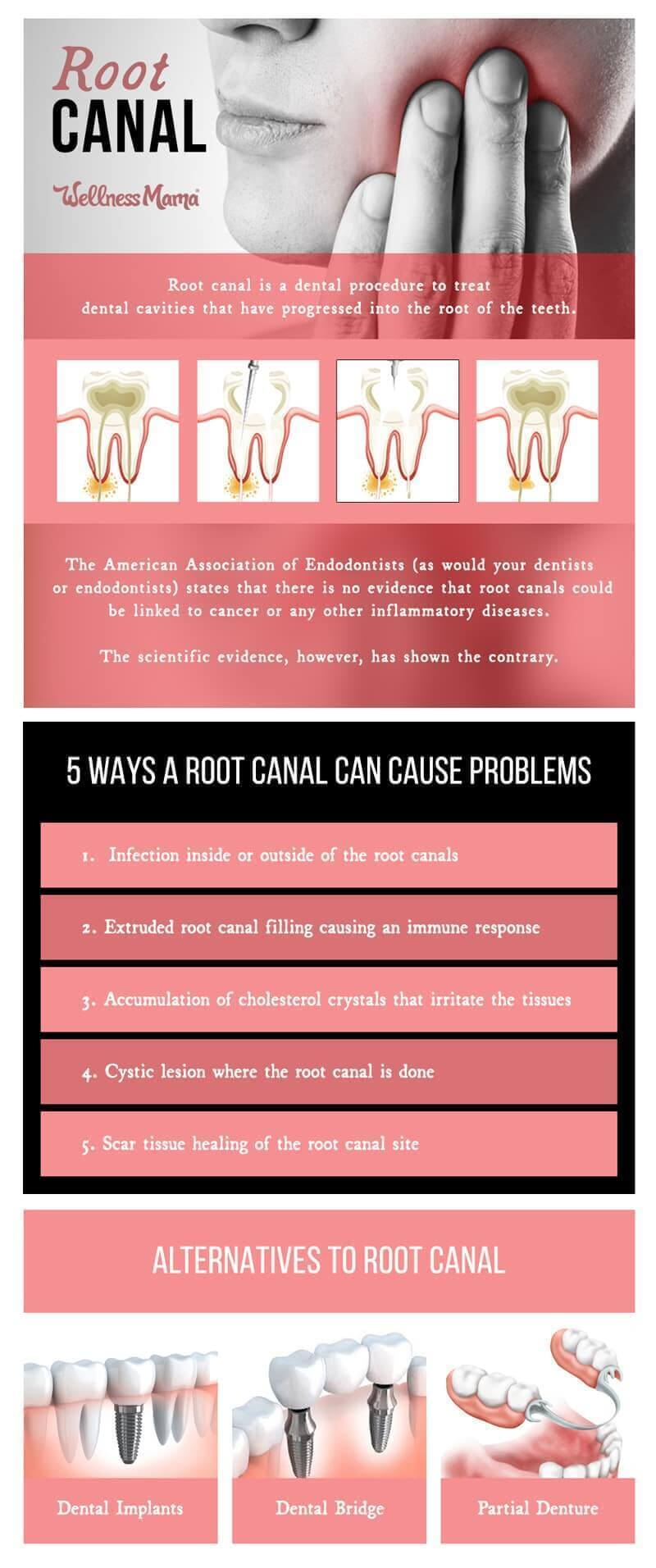 Ever wondered if a root canal is safe? Learn what the science says about the risks and ways to protect your health before your next procedure.