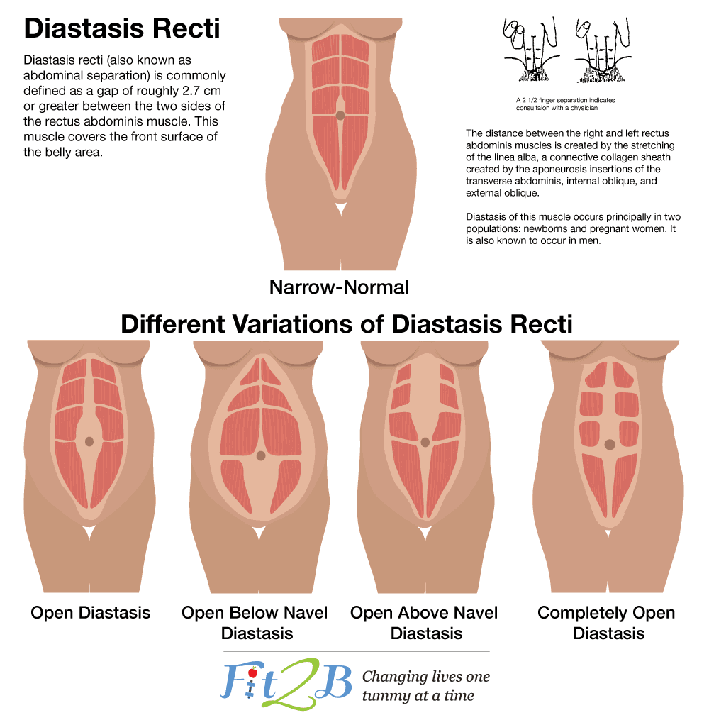 what is diastasis recti