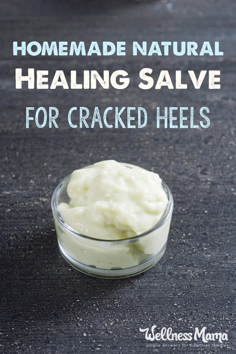 Cracked heels can be frustrating and painful. These homemade remedies like detoxifying foot soaks, supplements and DIY salve can help cracked heels.