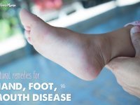 Natural Remedies for Hand Foot and Mouth Disease