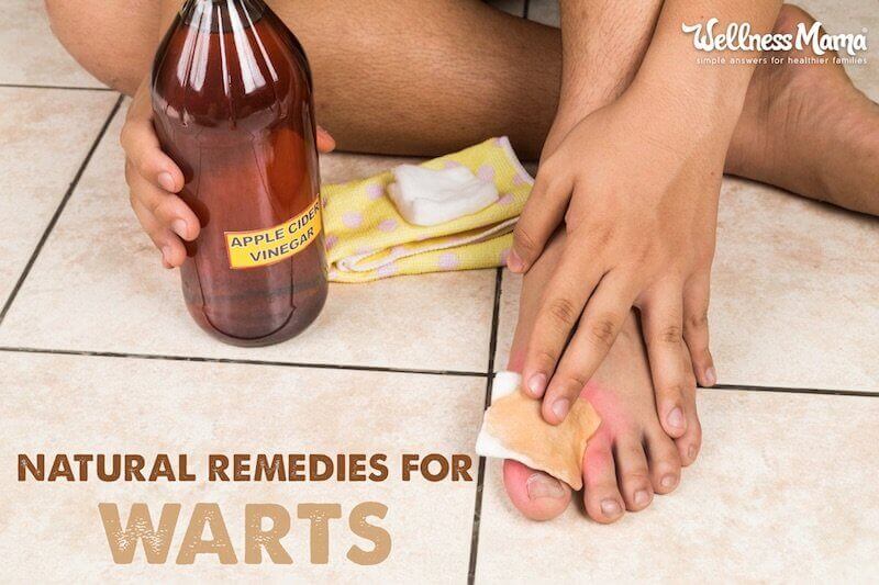 Natural remedies for warts