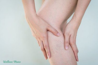 remedies for varicose veins